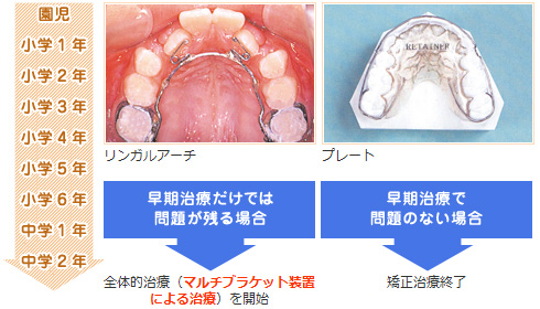 神戸市北区・三田市、おかだ矯正歯科クリニックの子どもの矯正